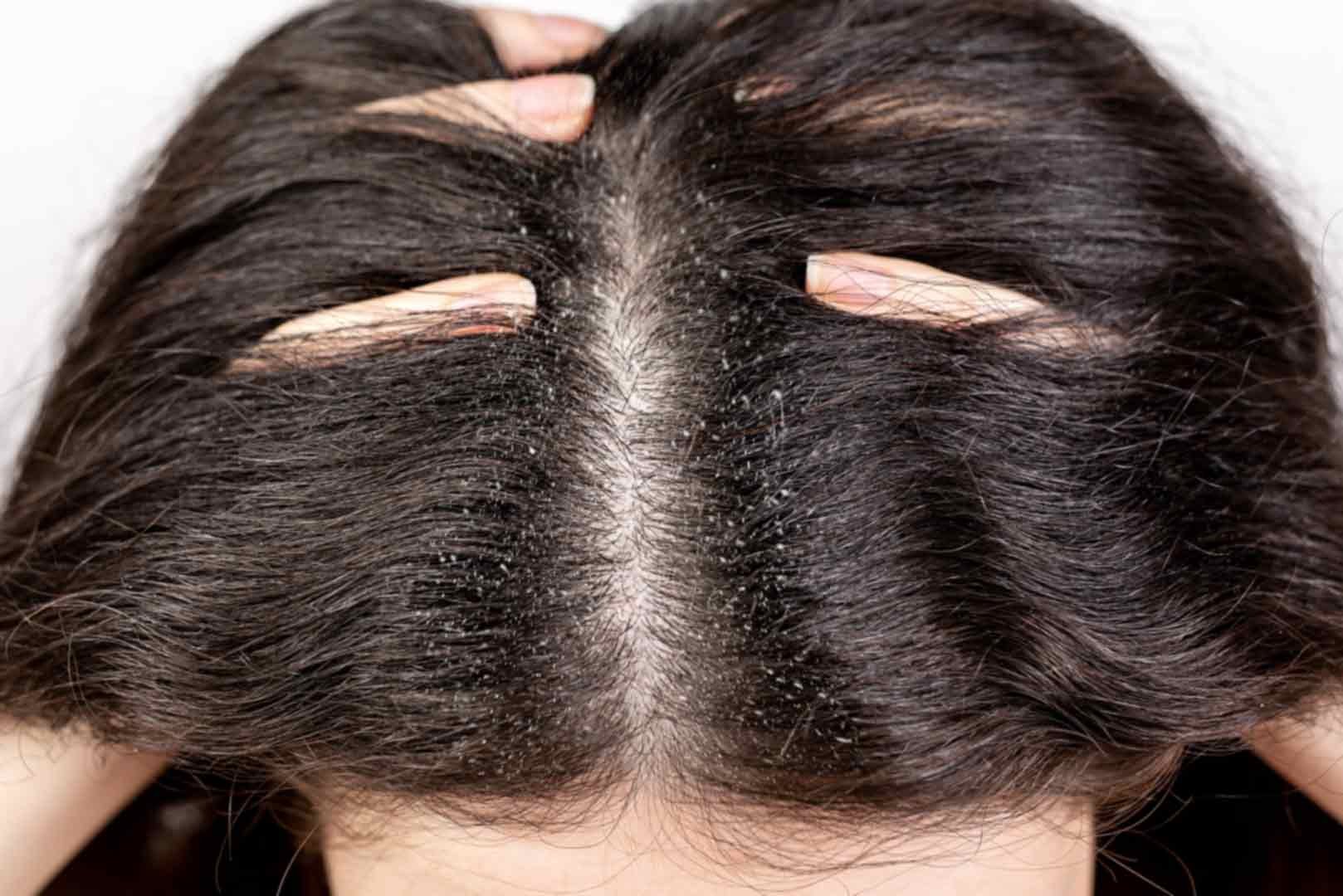 new-symbiose-rambut-sehat-bebas-ketombe